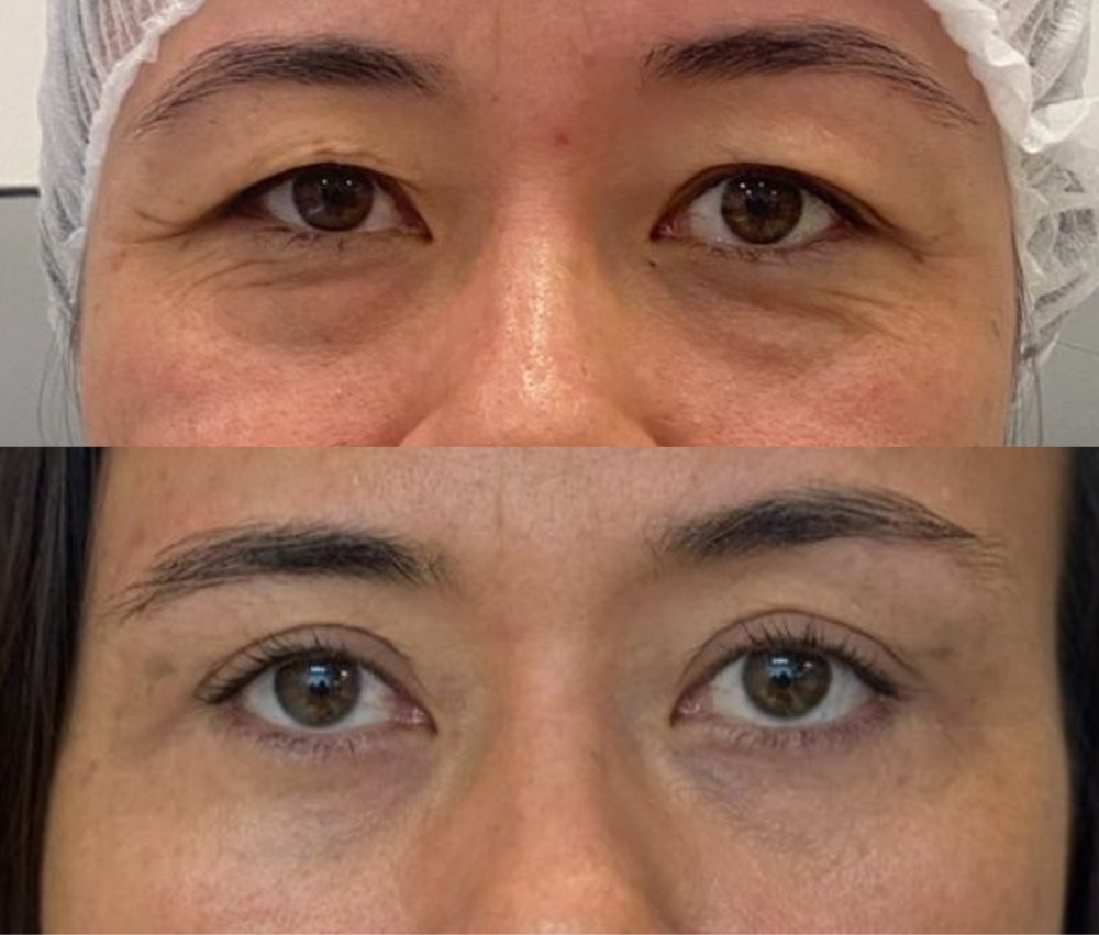 Antes e depois — cirurgia de pálpebras com a Dra. Lívia Lanzoni