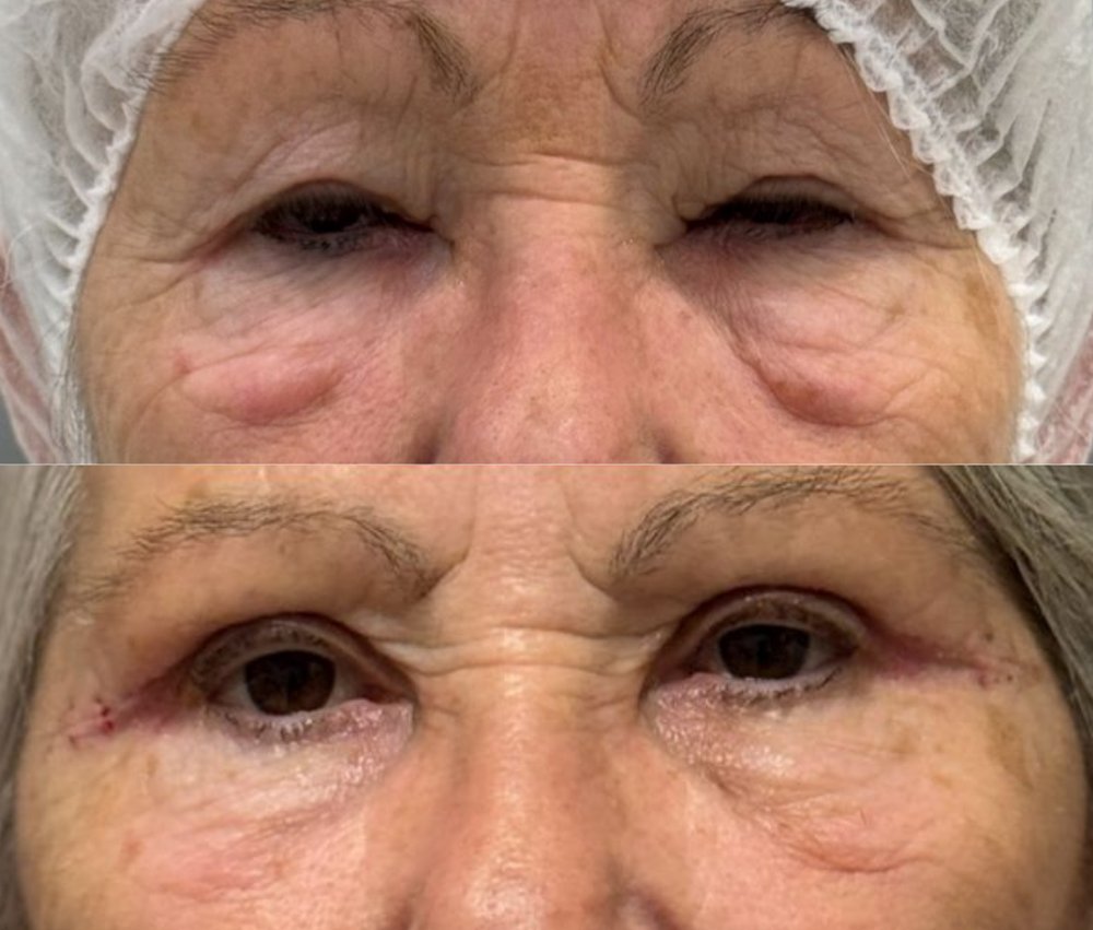 Antes e depois — cirurgia de pálpebras com a Dra. Lívia Lanzoni